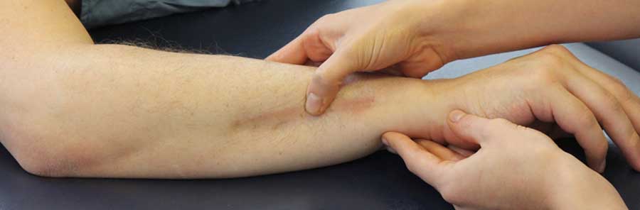 Scar Tissue & Adhesions - Arancia Physical Therapy